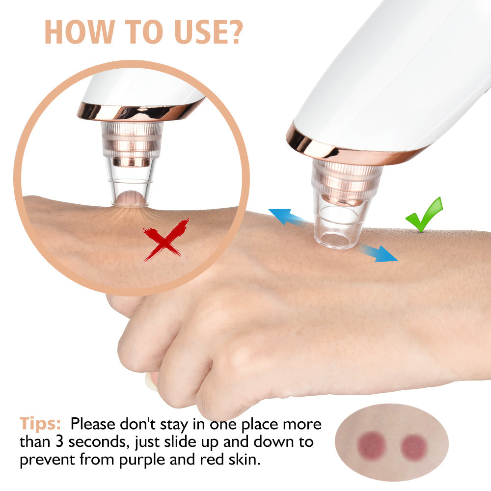 5 in 1 Blackhead Vacuum Cleaner β Instantly Remove Blackheads at Home
